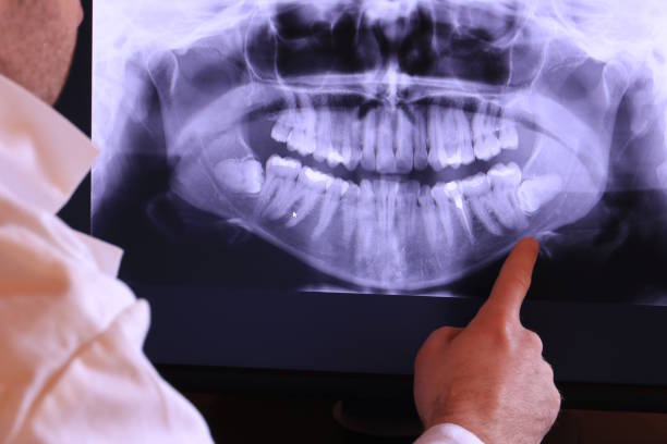 Best Emergency Treatment for Dental Infections or Abscesses in New Canaan, CT